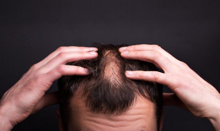 Czy istnieją skuteczne sposoby na męskie łysienie?